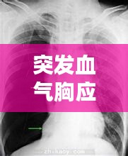 突发血气胸应急预案:突发气胸急救措施