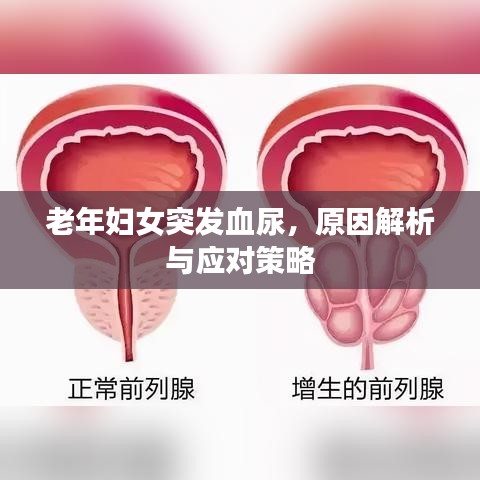 老年妇女突发血尿,原因解析与应对策略